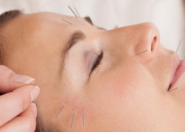 Kvinna behandlas med akupunktur i ansiktet